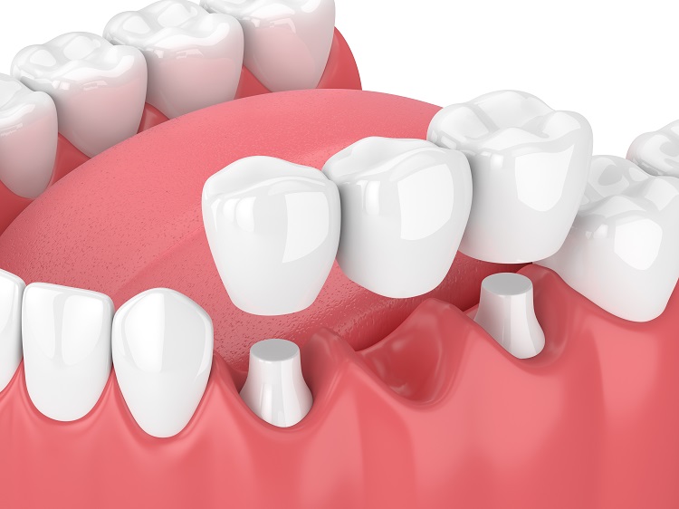 Cầu răng sứ là gì? Chọn loại cầu răng sứ phù hợp