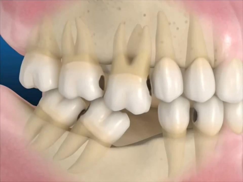 Trồng răng implant – Phục hình hoàn hảo cho người mất răng lâu năm - nhakhoathuyanh