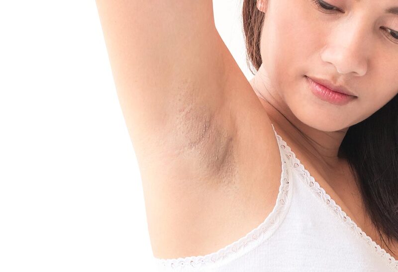 Waxing lông nách có bị thâm không? Cách tẩy lông không bị thâm tại nhà