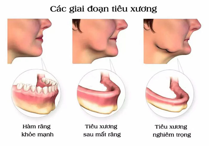 Mất răng lâu ngày dẫn đến tiêu xương hàm